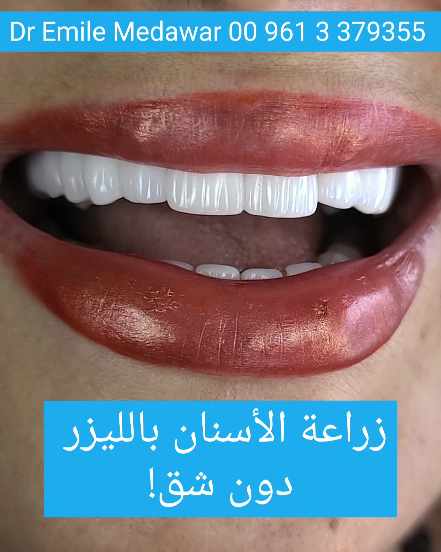 Laser dental implant procedure in Beirut