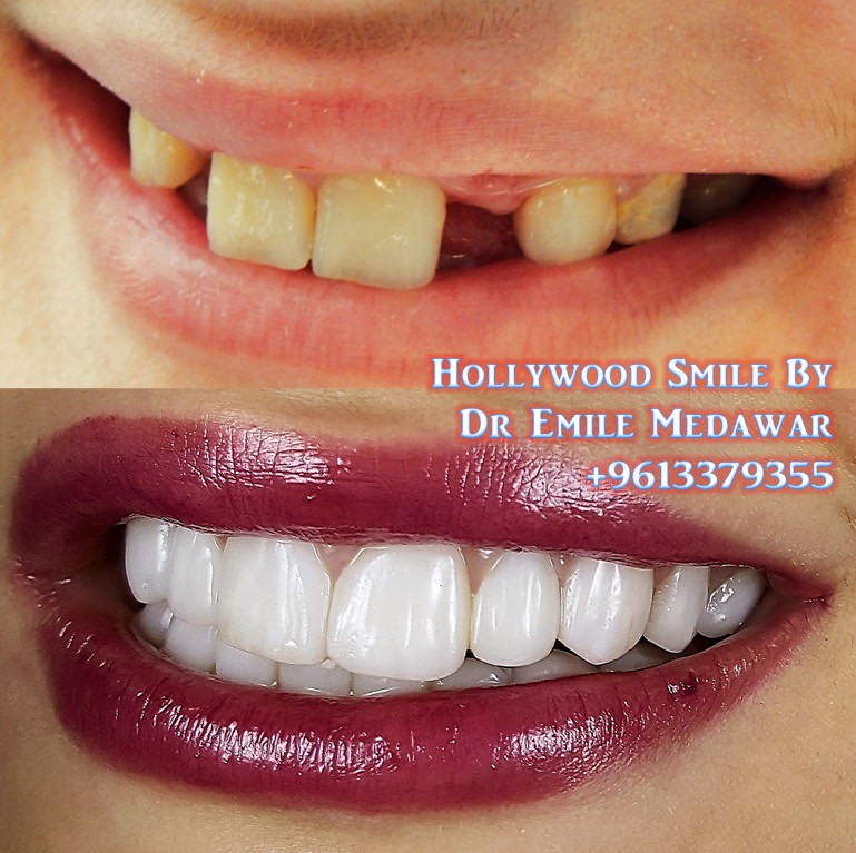 Dental implant before and after results