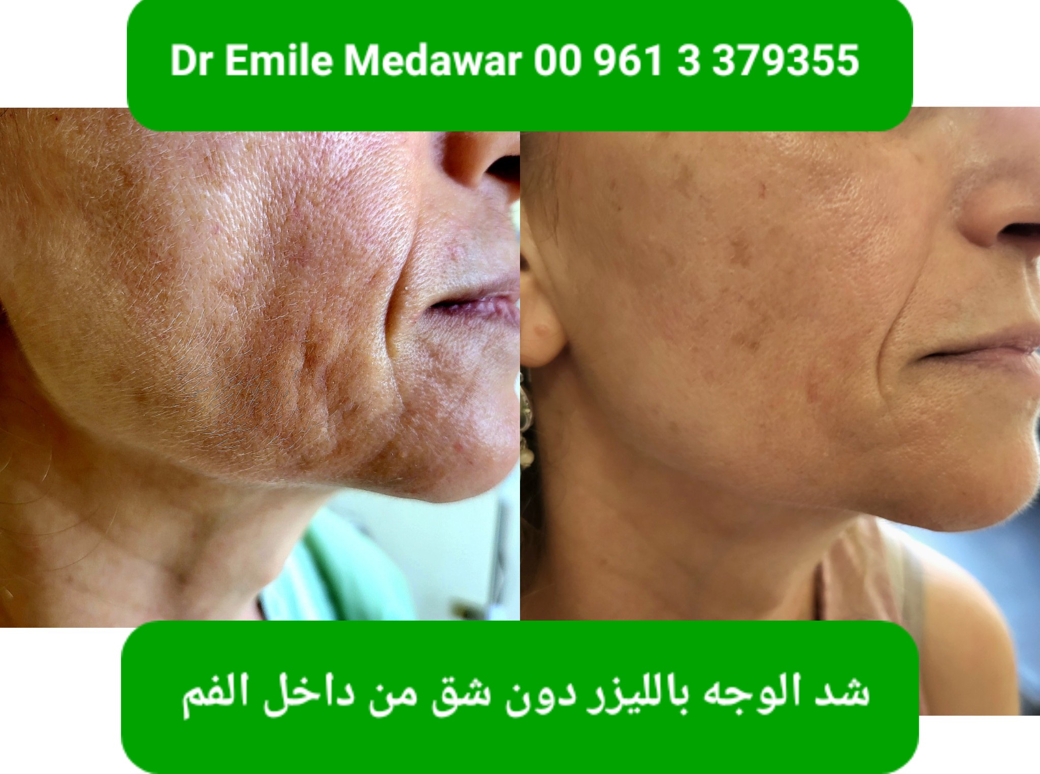 Intraoral laser face lift procedure in Beirut Lebanon