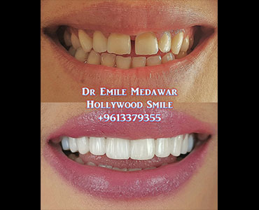 veneers lebanon beirut