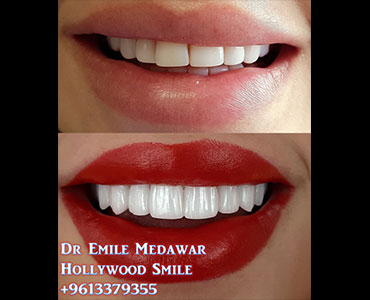 3D Digital Porcelain Veneers