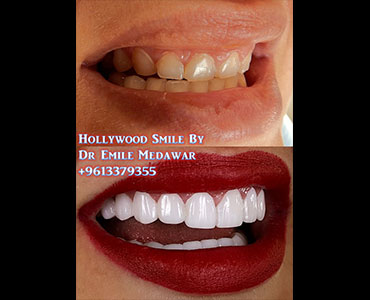 3D Digital Porcelain Veneers