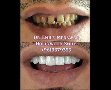 veneers price lebanon
