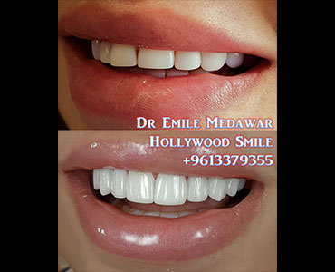 porcelain veneers lebanon