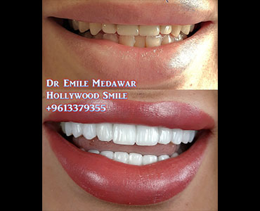 best veneers lebanon