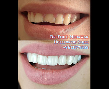 veneers lebanon beirut