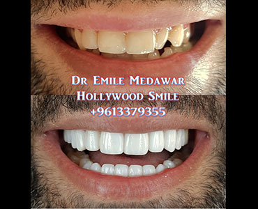porcelain veneers lebanon