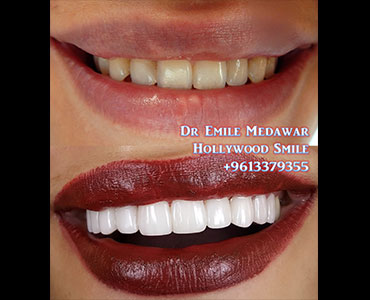 dentist lebanon veneers