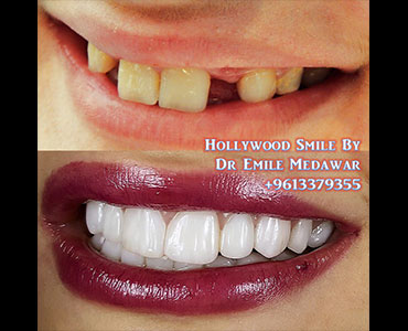 dental implants lebanon