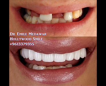 Dental implants