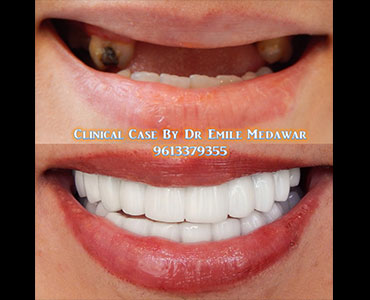 dental implants price lebanon