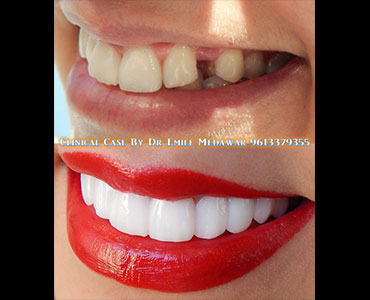 dental implants cost lebanon