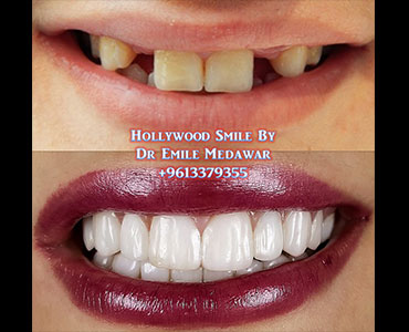 dental implants lebanon