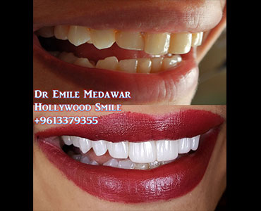 Direct Composite Veneers