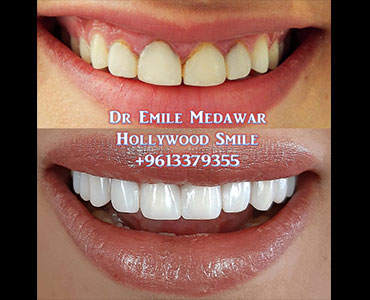 Direct Composite Veneers