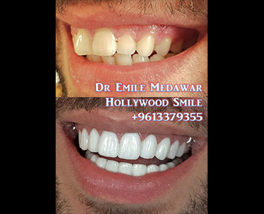emax veneers lebanon