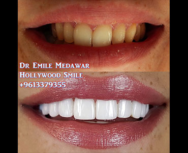 veneers lebanon price