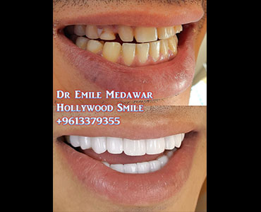 emax veneers lebanon beirut