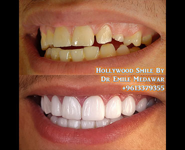 emax veneers dentist lebanon