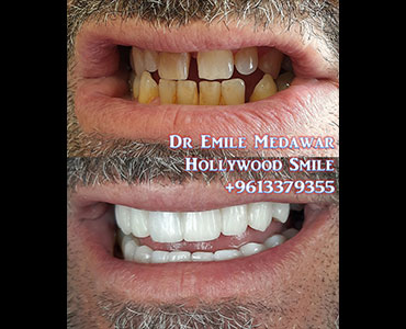 teeth whitening lebanon