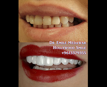 E-Max Veneers