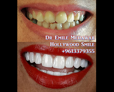 E-Max Veneers