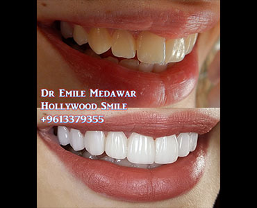 فينيرز لبنان