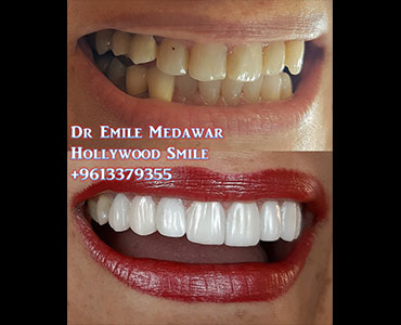 تجميل اسنان لبنان