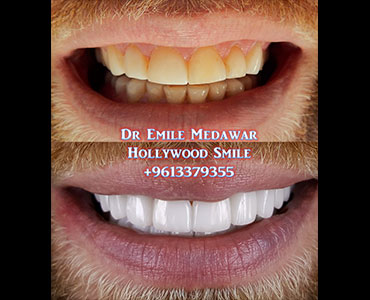 emax veneers lebanon beirut