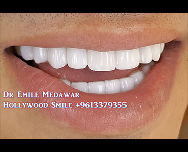 زراعة اسنان لبنان