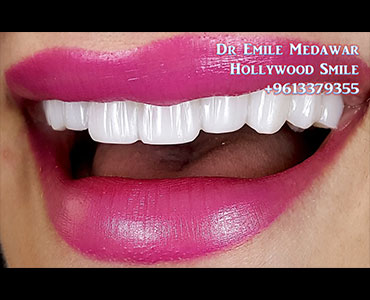 تجميل اسنان بيروت