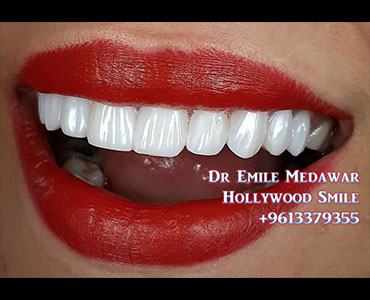 Hollywood Smile lebanon beirut