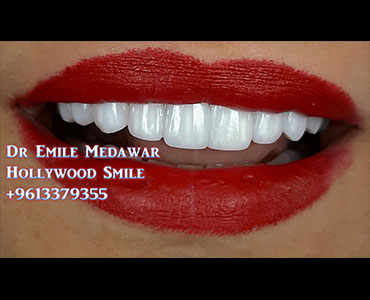 Hollywood Smile lebanon beirut 1