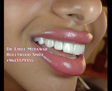 Hollywood Smile lebanon beirut 1