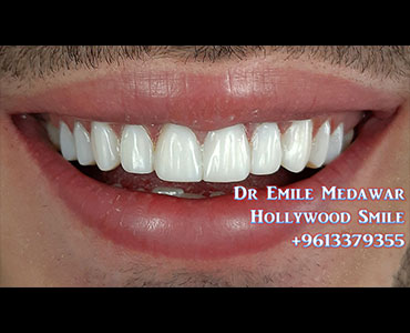 Hollywood Smile