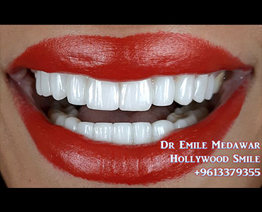 هوليوود سمايل لبنان