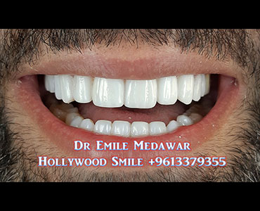 veneers lebanon