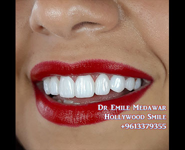 veneers beirut