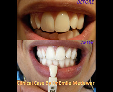 Laser Teeth Whitening