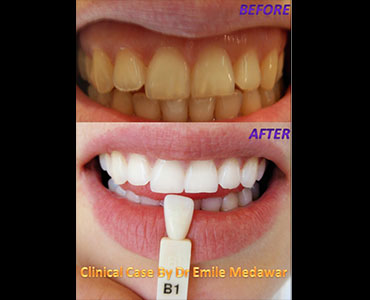 Laser Teeth Whitening