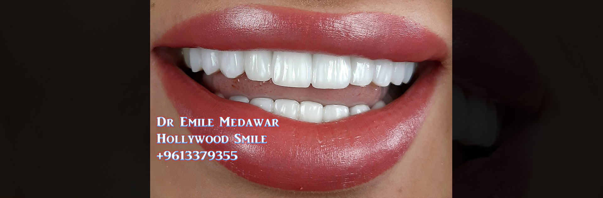 teeth whitening lebanon