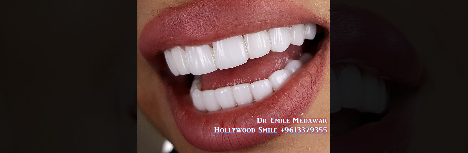best veneers in Lebanon beirut