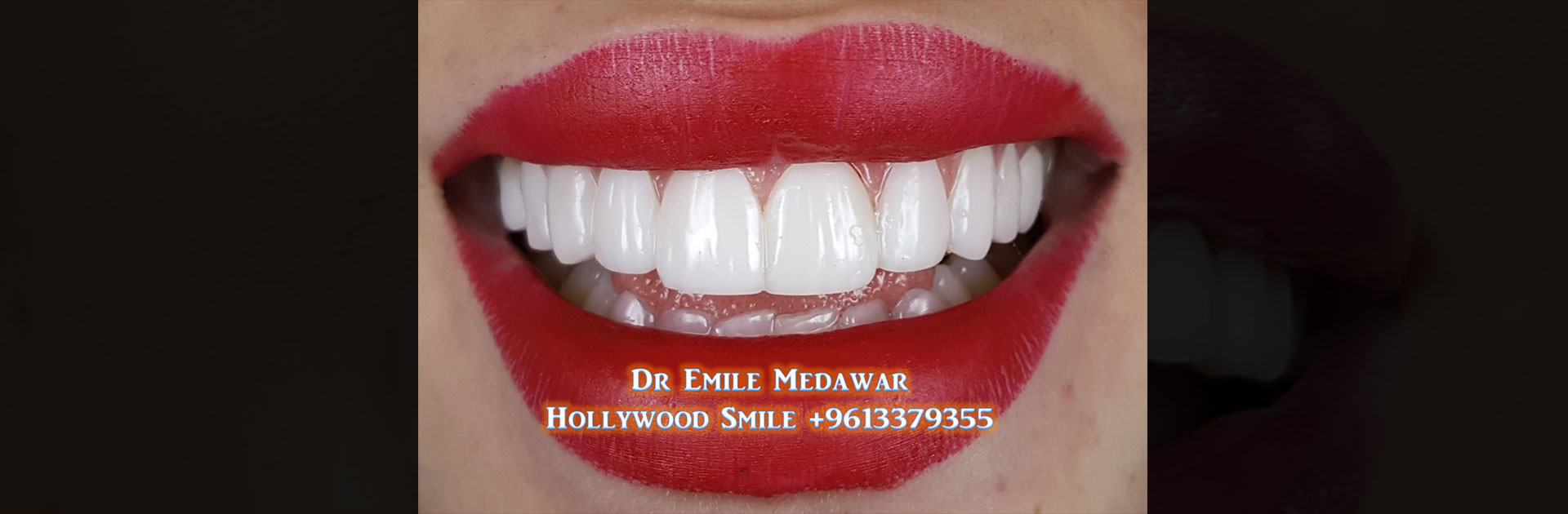 تجميل اسنان لبنان