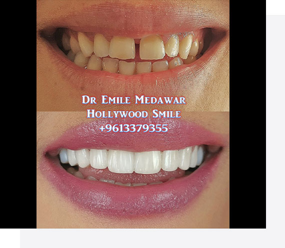 3D Digital Porcelain Veneers
