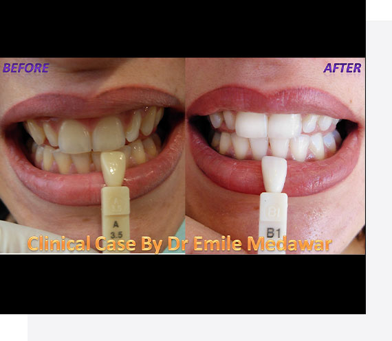 Laser Teeth Whitening